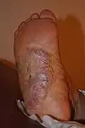 جدرة في باطن القدم
