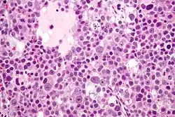 Micrograph of a spermatocytic tumor. صبغة الهيماتوكسيلين واليوزين.