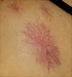 ورم وعائي عنكبي