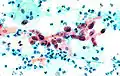 سرطان خلايا حرشفية في عنق الرحم باستخدام فحص عنق الرحم ( بالانجليزي: pap test)