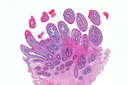 Micrograph showing a squamous papilloma of the tongue. صبغة الهيماتوكسيلين واليوزين.