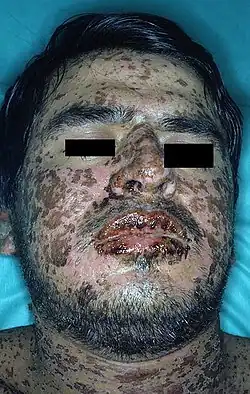 متلازمة ستيفنس جونسون