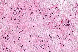 صورة مجهرية لورم البطانة العصبية وتحتها تظهر التجمع المميز للنوى. صبغة الهيماتوكسيلين واليوزين.