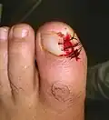 عرن تحت الظفر (3/3)، بعد الاستئصال.
