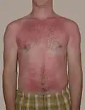 حرق الشمس هو حرق نموذجي من الدرجة الأولى.
