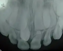 أسنان زائدة في مقدمة الفك العلوي