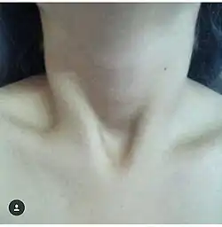 &nbsp;الشق الوداجي (الثلمة فوق القص).