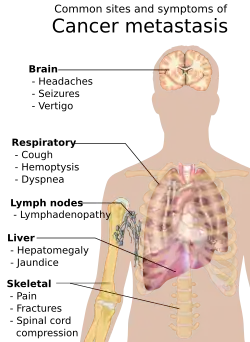 Symptoms of cancer can be based on the affected organs
