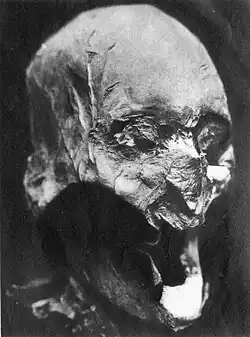 Alleged skull of Henry IV in 1933; his tomb was ransacked during the الثورة الفرنسية. This skull didn't match the DNA of Louis XIII's descendants in 2013. Also, this skull doesn't match Louis XVII's heart on mtDNA. The mtDNA haplogroup of the skull is U5b* 16311T>C.