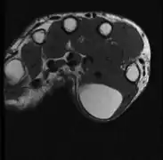 T1 MRI لنفس الورم الشحمي: كتلة إشارة عالية الكثافة مع مناطق ذات هوامش غير محددة بدقة.