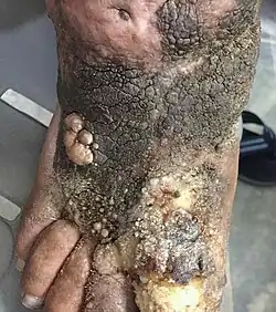 داء الفيل المتوطن