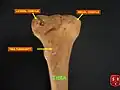 اللّقمة الوحشية لعظم الظنبوب ظاهرة.