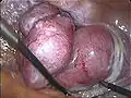 استخراج الرحم بالمنظار بالكامل