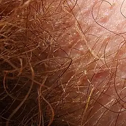 An armpit with variably encrusted hairs