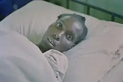 سحنة أبقراطية