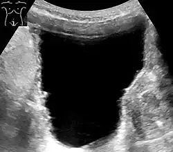صورة صوتية لمثانة رجل