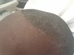 صقيع يوريمي موجود على جبين وفروة رأس شاب يشتكي من فقدان الشهية والتعب، مع نيتروجين يوريا الدم ومستويات الكرياتينين في الدم تقارب 100 و50 ملغ/ديسيلتر على التوالي..