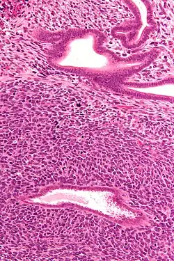 صورة مجهرية of a uterine adenosarcoma showing a mitotically active malignant خلية سدوية and benign غدةs. صبغة الهيماتوكسيلين واليوزين.