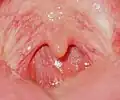 الحنك الرخو بدون اللوزتين (بعد إجراء عملية استئصال اللوزتين).