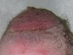 فروة رأس طفل تُظهر آثار عملية الشفط.