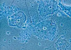 صورة مجهرية للبكتيريا المهبلية - الأنسجة الطلائية لعنق الرحم مغطاة ببكتيريا تشبه العصيات، Gardnerella vaginalis (أسهم).