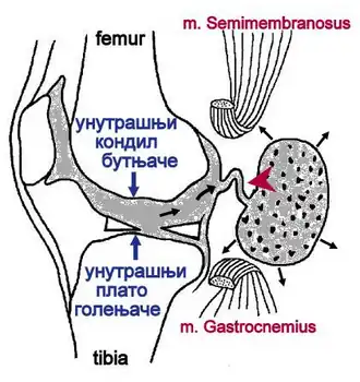 كيسة بيكر