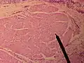 مقطع في العضلات الصوتية (بالإنجليزية: vocalis muscle).