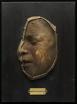منظر جانبي لقالب شمعي لوجه طفل يُظهر الورم الغدي الزهمي (اضطراب جلدي وراثي)، أوائل القرن العشرين