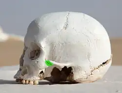 درز وجني صدغي (ملون باللون الأخضر)