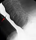 منظر جانبي لتضيق المريء بالوترة.