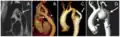 تضيق الأبهر باستخدام تقنيات التصوير المختلفة