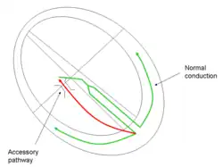 Conduction pathway in atrioventricular reentrant tachycardia, a form of تسرع القلب فوق البطيني